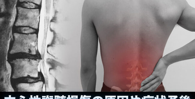 中心性脊髄損傷の原因や症状と予後について