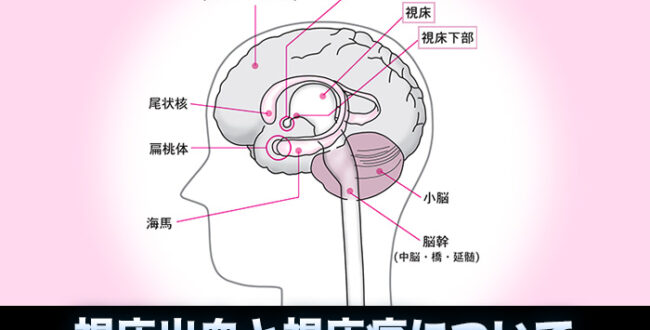 視床出血と視床痛について